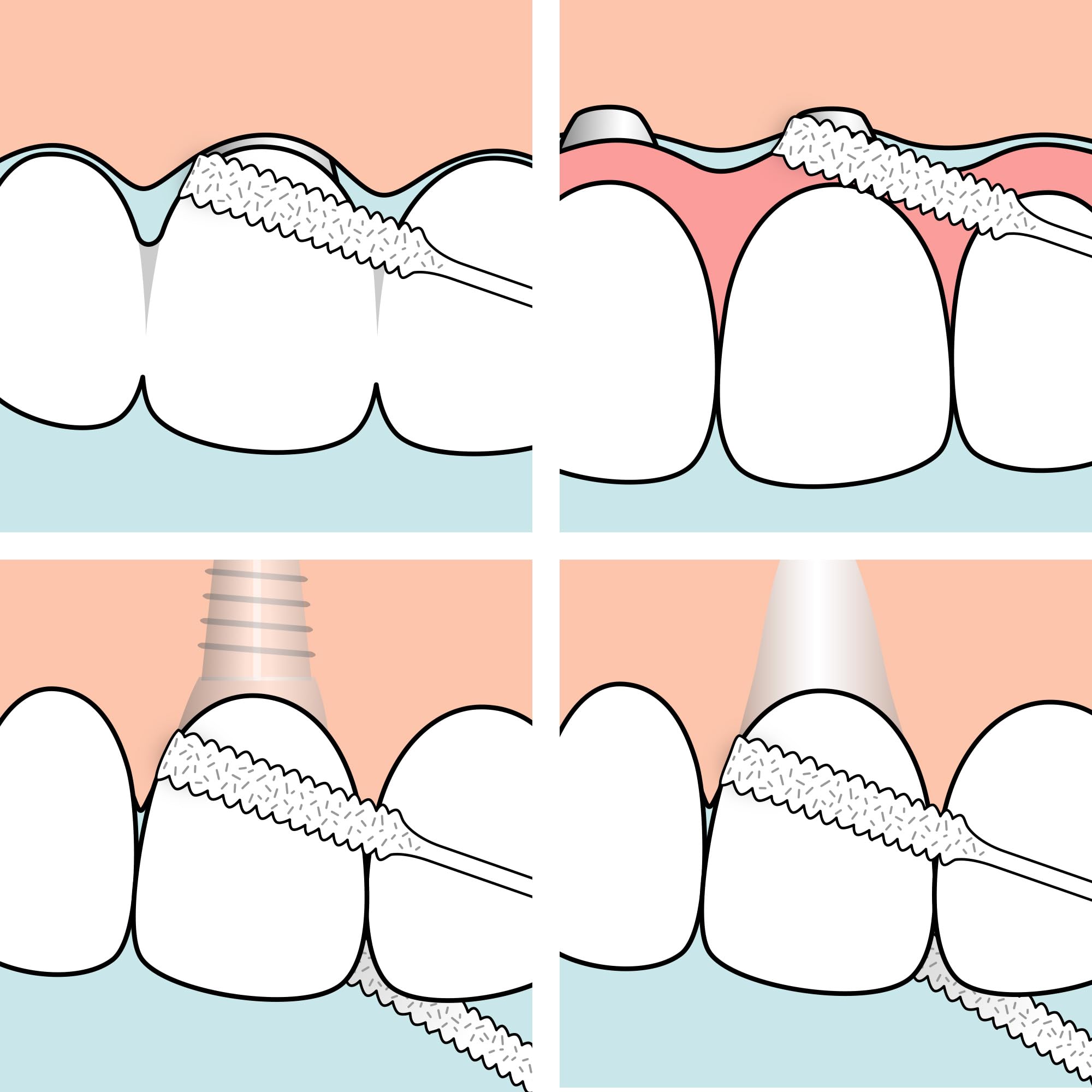 TePe Bridge and Implant Floss for Dental Implants, Bridges, and Braces, Dental Flossers, 30 Pieces