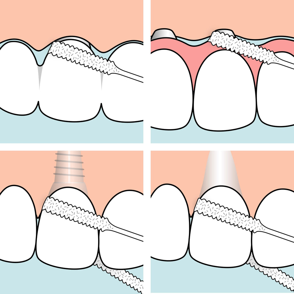 TePe Bridge and Implant Floss for Dental Implants, Bridges, and Braces, Dental Flossers, 30 Pieces